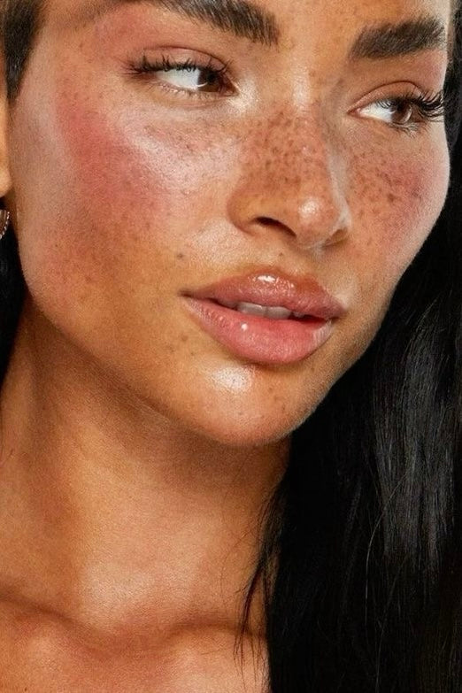 Comedonal Acne vs. Fungal Acne: The Chic Girl’s Spotting Guide