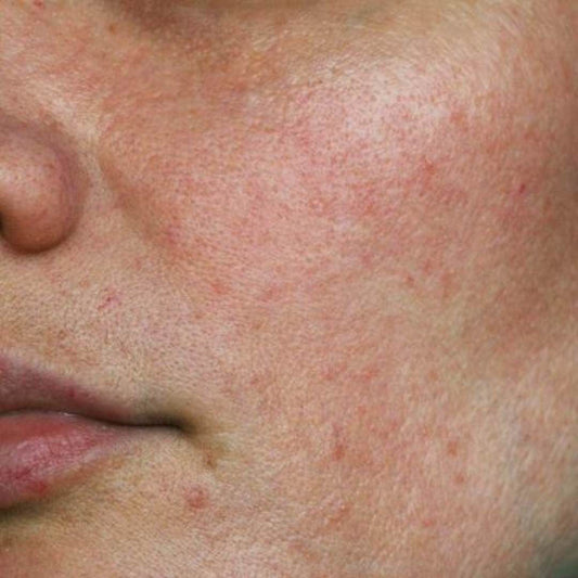The Ultimate Guide to Comedonal Acne